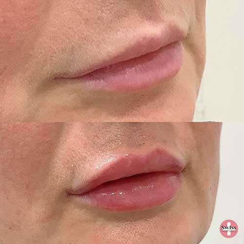 Swiss Aesthetics What are the benefits of Dermal Filler?