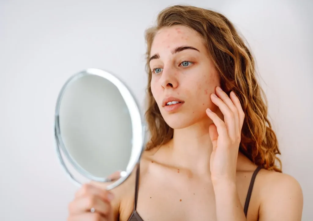Microneedling Benefits: How the Treatment Improves Skin Texture and Scarring